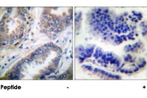 Immunohistochemical analysis of paraffin-embedded human lung carcinoma tissue using CASP9 polyclonal antibody . (Caspase 9 anticorps)