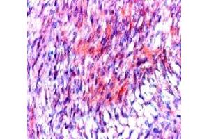 Formalin fixed paraffin embedded human stromal tumor stained with CD117 / c-kit antibody. (KIT anticorps  (C-Term))