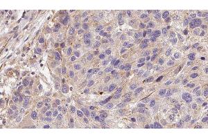 ABIN6278573 at 1/100 staining Human melanoma tissue by IHC-P. (GAS6 anticorps  (Internal Region))
