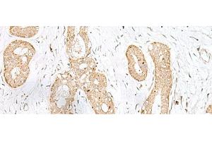 Immunohistochemistry of paraffin-embedded Human breast cancer tissue using BEX2 Polyclonal Antibody at dilution of 1:45(x200) (BEX2 anticorps)