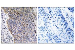 Immunohistochemistry analysis of paraffin-embedded human lung carcinoma tissue using MGST3 antibody. (MGST3 anticorps  (N-Term))