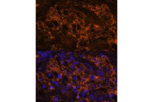 Immunofluorescence analysis of human kidney cancer using SLC7 antibody (ABIN6130697, ABIN6148048, ABIN6148049 and ABIN6216625) at dilution of 1:100. (SLC7A9 anticorps  (AA 1-100))