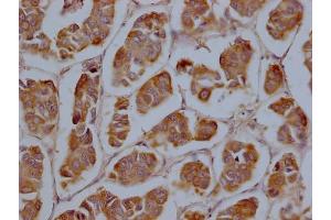 IHC image of ABIN7149222 diluted at 1:200 and staining in paraffin-embedded human breast cancer performed on a Leica BondTM system.