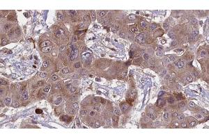 ABIN6269005 at 1/100 staining Human liver cancer tissue by IHC-P. (Metabotropic Glutamate Receptor 4 anticorps  (C-Term))