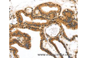 Immunohistochemistry of Human thyroid cancer using SERPINB8 Polyclonal Antibody at dilution of 1:40 (SERPINB8 anticorps)