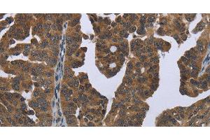 Immunohistochemistry of paraffin-embedded Human ovarian cancer tissue using GYS2 Polyclonal Antibody at dilution 1:50 (Glycogen Synthase 2 anticorps)