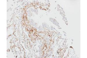 IHC-P Image Immunohistochemical analysis of paraffin-embedded human lung fibrose tissue, using SGLT1, antibody at 1:100 dilution. (SLC5A1 anticorps  (Center))