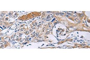 Immunohistochemistry of paraffin-embedded Human esophagus cancer tissue using FBXO45 Polyclonal Antibody at dilution of 1:40(x200) (FBXO45 anticorps)
