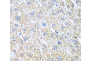 Immunohistochemistry of paraffin-embedded Human liver cancer using PTGS1 Polyclonal Antibody at dilution of 1:100 (40x lens).