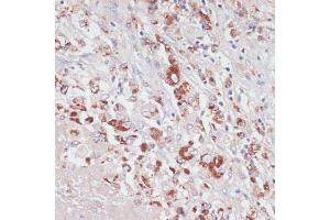 Immunohistochemistry of paraffin-embedded human liver cancer using Lysozyme (Lysozyme (LYZ)) antibody (ABIN6133802, ABIN6143409, ABIN6143412 and ABIN6217538) at dilution of 1:100 (40x lens). (LYZ anticorps  (AA 1-100))