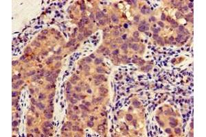 Immunohistochemistry of paraffin-embedded human pancreatic cancer using ABIN7143570 at dilution of 1:100