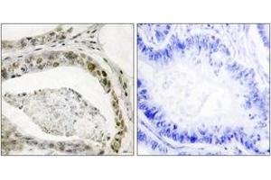 Immunohistochemistry analysis of paraffin-embedded human colon carcinoma, using Smad3 (Phospho-Ser208) Antibody.