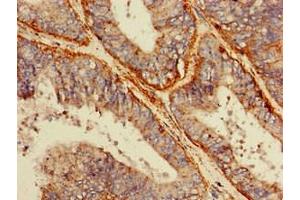 Immunohistochemistry of paraffin-embedded human endometrial cancer using ABIN7158800 at dilution of 1:100