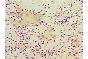 Immunohistochemistry of paraffin-embedded human breast cancer using ABIN7166413 at dilution of 1:100