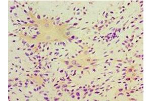 Immunohistochemistry of paraffin-embedded human breast cancer using ABIN7166413 at dilution of 1:100 (Transglutaminase 2 anticorps  (AA 438-687))