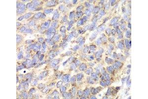 Immunohistochemistry of paraffin-embedded Human esophageal cancer using ACY1 Polyclonal Antibody at dilution of 1:100 (40x lens). (Aminoacylase 1 anticorps)