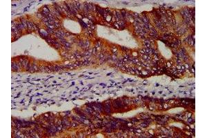 IHC image of ABIN7164068 diluted at 1:100 and staining in paraffin-embedded human colon cancer performed on a Leica BondTM system.