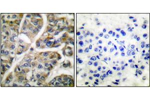 Immunohistochemical analysis of paraffin-embedded human breast carcinoma tissue using Granzyme B antibody. (GZMB anticorps)
