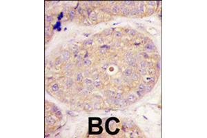 Formalin-fixed and paraffin-embedded human breast carcinoma tissue reacted with GGPS1 polyclonal antibody  , which was peroxidase-conjugated to the secondary antibody, followed by DAB staining . (GGPS1 anticorps  (C-Term))