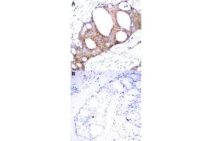 Immunohistochemical staining of human breast cancer tissue by GSK3A (phospho S21) polyclonal antibody  without blocking peptide (A) or preincubated with blocking peptide (B) under 1:50-1:100 dilution. (GSK3 alpha anticorps  (pSer21))