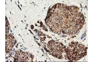 Immunohistochemical staining of paraffin-embedded Adenocarcinoma of Human breast tissue using anti-CLPP mouse monoclonal antibody.