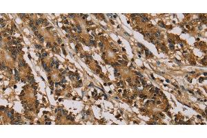 Immunohistochemistry of paraffin-embedded Human colon cancer using PSMC2 Polyclonal Antibody at dilution of 1:30