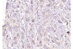 ABIN6269189 at 1/100 staining Human breast cancer tissue by IHC-P. (Filamin A anticorps  (Internal Region))