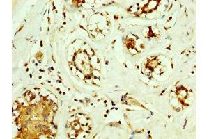 IHC image of ABIN7170983 diluted at 1:560 and staining in paraffin-embedded human breast cancer performed on a Leica BondTM system.