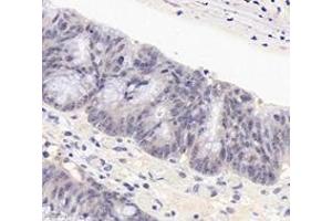 Immunohistochemistry analysis of paraffin-embedded human colon cancer using PARN (ABIN7075117) at dilution of 1: 1800 (PARN anticorps)