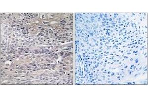 Immunohistochemistry analysis of paraffin-embedded human thyroid gland tissue, using IREB1 (Ab-711) Antibody. (Aconitase 1 anticorps  (AA 681-730))