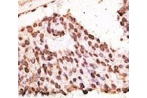 IHC analysis of FFPE human breast carcinoma tissue stained with the MMP7 antibody (MMP7 anticorps  (AA 117-146))