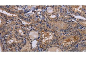 Immunohistochemistry of paraffin-embedded Human thyroid cancer using FADS1 Polyclonal Antibody at dilution of 1:60 (FADS1 anticorps)