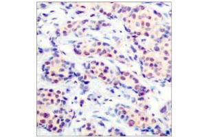 Immunohistochemical analysis of paraffin-embedded human breast carcinoma tissue using JunD (Ab-255) antibody (E021028). (JunD anticorps)
