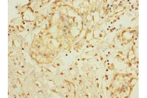 Immunohistochemistry of paraffin-embedded human breast cancer using ABIN7150051 at dilution of 1:100 (ADAM28 anticorps  (AA 199-440))