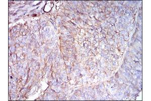 Immunohistochemical analysis of paraffin-embedded ovarian cancer tissues using B2M mouse mAb with DAB staining.