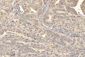 Immunohistochemistry analysis of paraffin-embedded human uterine cancer using TPPP3 (ABIN7076047) at dilution of 1: 3000