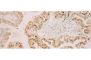 Immunohistochemistry of paraffin-embedded Human liver cancer tissue using RFX6 Polyclonal Antibody at dilution of 1:50(x200) (RFX6 anticorps)