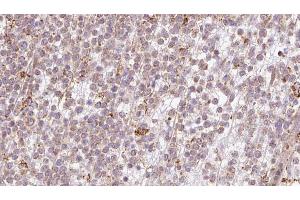 ABIN6273200 at 1/100 staining Human lymph cancer tissue by IHC-P.