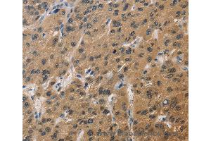 Immunohistochemistry of Human thyroid cancer using DUSP26 Polyclonal Antibody at dilution of 1:60 (DUSP26 anticorps)