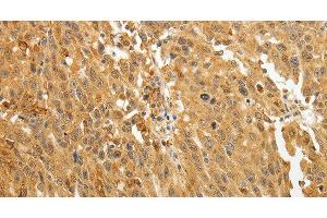 Immunohistochemistry of paraffin-embedded Human ovarian cancer using AKR1A1 Polyclonal Antibody at dilution of 1:30