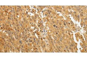 Immunohistochemistry of paraffin-embedded Human ovarian cancer using AKR1A1 Polyclonal Antibody at dilution of 1:30 (AKR1A1 anticorps)