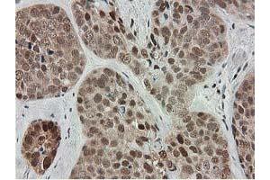Immunohistochemical staining of paraffin-embedded Adenocarcinoma of Human breast tissue using anti-SMS mouse monoclonal antibody. (SMS anticorps)