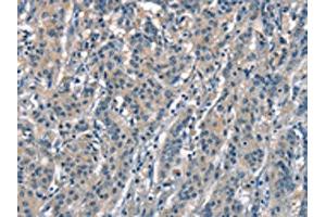 The image on the left is immunohistochemistry of paraffin-embedded Human gastric cancer tissue using ABIN7189631(ACPT Antibody) at dilution 1/30, on the right is treated with synthetic peptide. (Testicular Acid Phosphatase (ACP4) anticorps)
