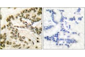 Immunohistochemistry analysis of paraffin-embedded human lung carcinoma tissue, using CREB (Ab-142) Antibody. (CREB1 anticorps  (AA 111-160))