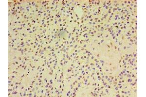 Immunohistochemistry of paraffin-embedded human breast cancer using ABIN7143455 at dilution of 1:100 (ARF6 anticorps  (AA 1-175))