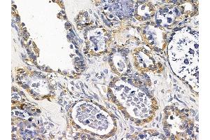 ABIN7093776 and ABIN7097817 at 1/100 staining human ovarian cancer by IHC-P.