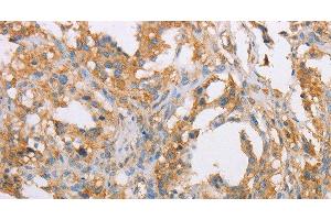 Immunohistochemistry of paraffin-embedded Human thyroid cancer tissue using ACTR2 Polyclonal Antibody at dilution 1:40 (ACTR2 anticorps)