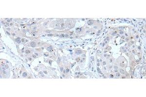 Immunohistochemistry of paraffin-embedded Human esophagus cancer tissue using ANGPTL6 Polyclonal Antibody at dilution of 1:55(x200) (ANGPTL6 anticorps)