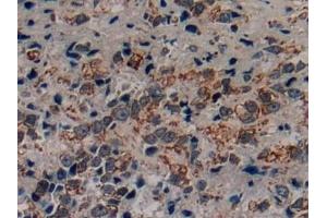 Detection of CRF in Human Prostate cancer Tissue using Polyclonal Antibody to Corticotropin Releasing Factor (CRF)