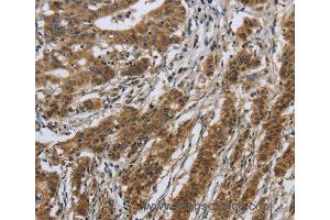 Immunohistochemistry of Human gastric cancer using IL5RA Polyclonal Antibody at dilution of 1:40 (IL5RA anticorps)